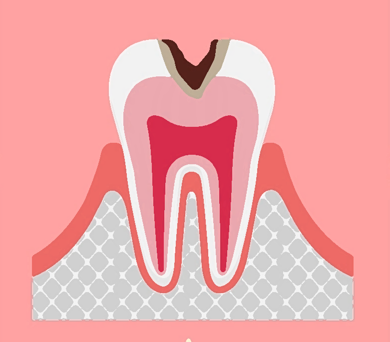 むし歯レベル2（C2）