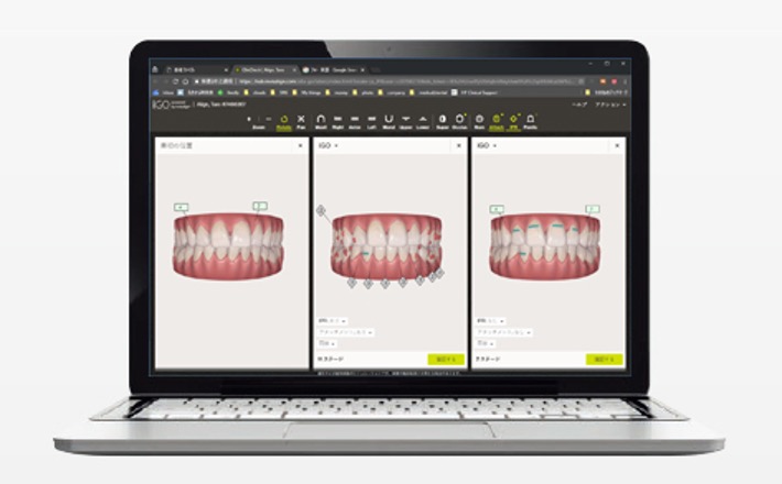 インビザライン社が独自に開発した３D治療計画ソフトウェアを使用し、歯科医師は患者さんの歯科記録に基づいてカスタマイズされた３Dの治療計画を作成します。この３Dの治療計画では、予測される最終的な歯並びが示されるほか、おおよその治療期間も提示されます。