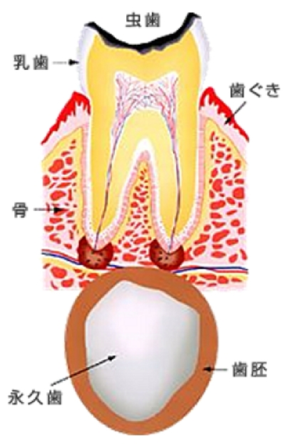 お子様のむし歯を放置すると・・・