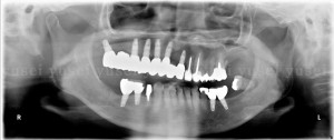 ２年ぶりに親知らずを抜き定期的なメインテナンスを始めた症例01