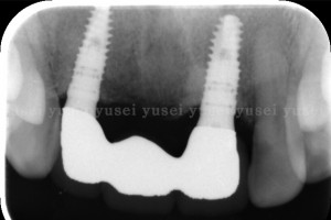 インプラント治療から６年ぶりの来院で経過良好と確認された症例01