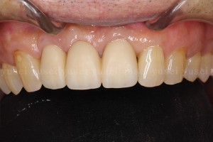 インプラント治療から６年ぶりの来院で経過良好と確認された症例02
