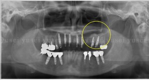 上顎洞底拳上手術を行い審美領域も含めた上顎に７本のインプラントを埋入した症例05