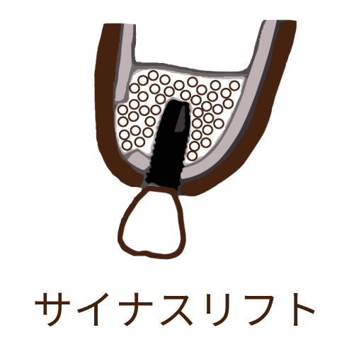 海外在住の患者さんにサイナスリフトとインプラント埋入を行った症例（飛行機に乗る時の注意点）